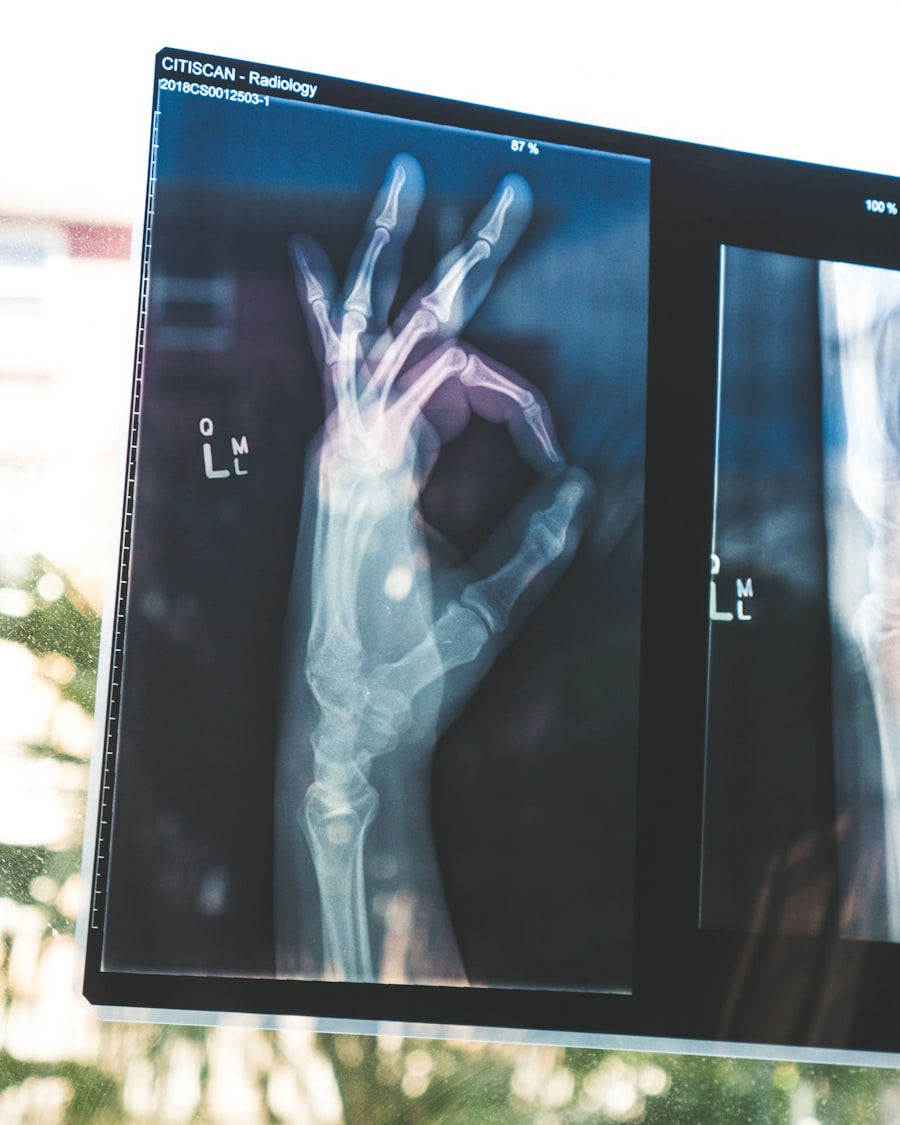 Digital X-ray
